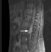 脊髓里面有个小肿瘤可以手术吗?脊髓肿瘤出国手术治疗