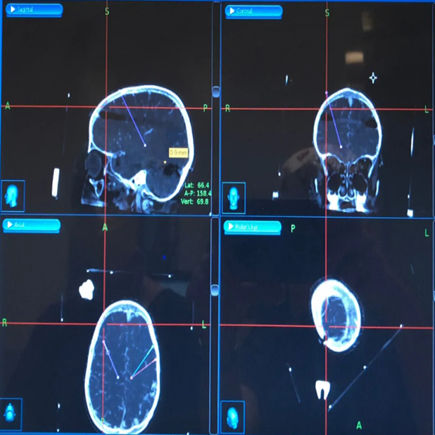 出国治疗癫痫：SickKids患者故事