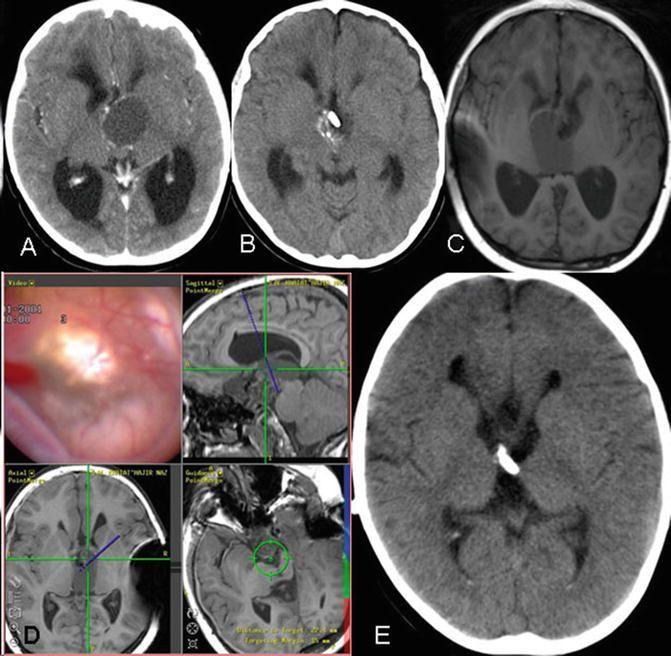 手术切除颅咽管瘤