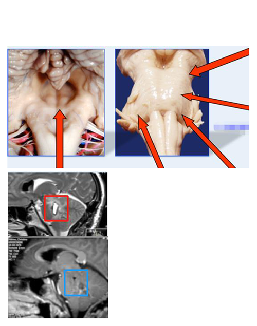 脑干海绵状血管瘤