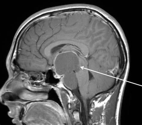 儿童期颅咽管瘤