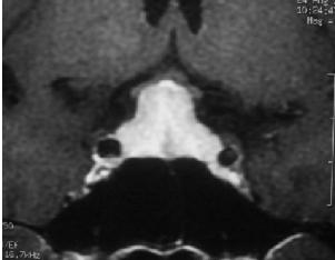 脑垂体瘤严重吗