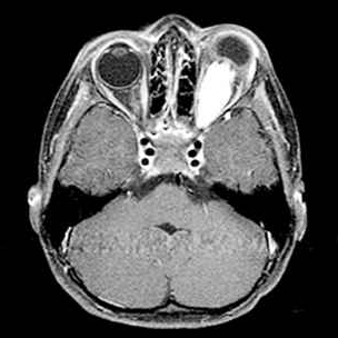 视神经胶质瘤能治好吗？手术后可以恢复视力吗？