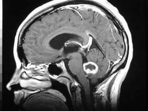 胶质瘤手术后遗症预防