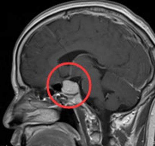身高2.4m超过姚明，原来是“脑垂体瘤”惹的祸！