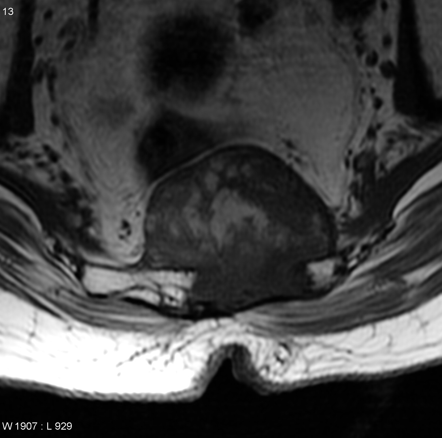 脊索瘤的症状有哪些？骶骨脊索瘤手术原则解读