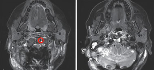 脑瘤案例图片