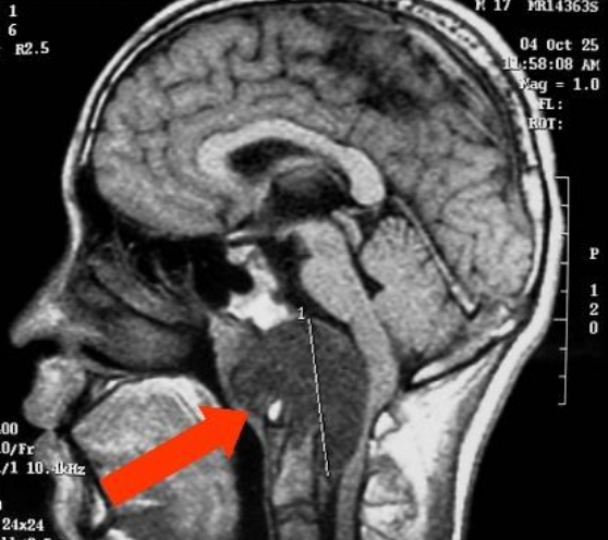 头部脊索瘤手术痛苦吗？