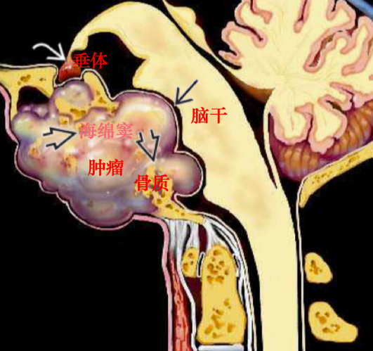 ［手术纪实篇］看WFNS颅底手术委员会主席切除斜坡、鞍旁脊索瘤