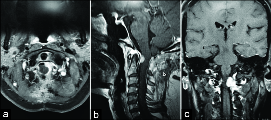 术后对比增强磁共振成像