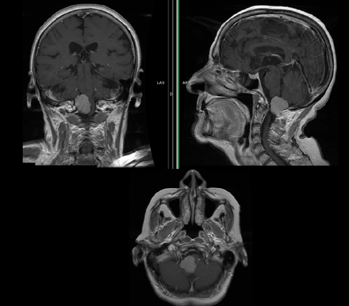 枕骨大孔区脑膜瘤：处理罕见病例的技术要点