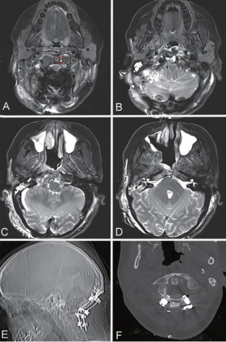 开颅手术后的术后影像