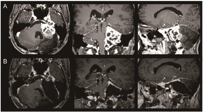 巨大听神经瘤手术案例图片