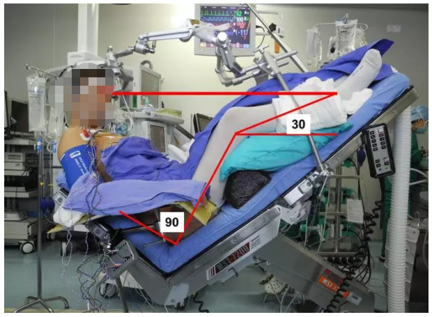 听神经瘤手术，真的一做就耳聋、面瘫吗？真相在这里