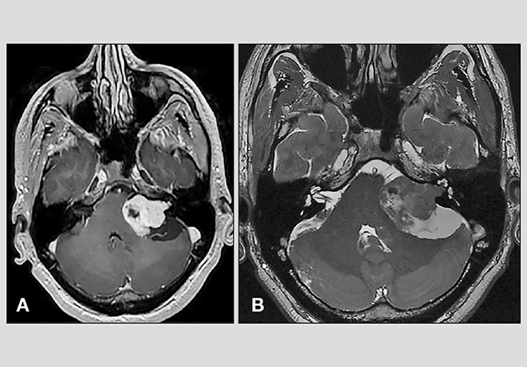 <a href='/bingzhong/tsjl/' target='_blank'><u>听神经瘤</u></a>手术