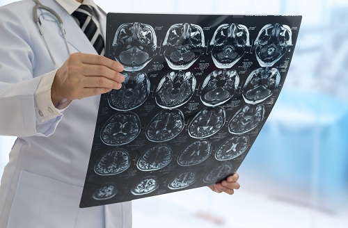 不孕不育警惕垂体瘤，难治性垂体瘤如何治疗？