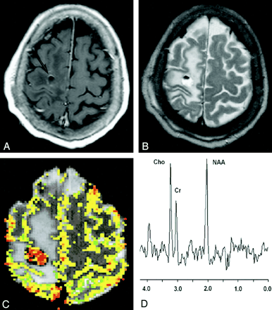 低级别神经胶质瘤