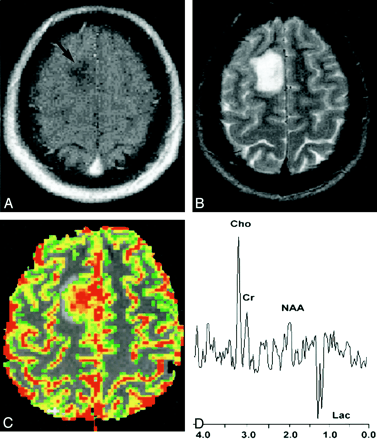 脑胶质瘤的级别：灌注MR成像和质子MR光谱成像与常规MR成像相比的敏感性，特异性和预测价值