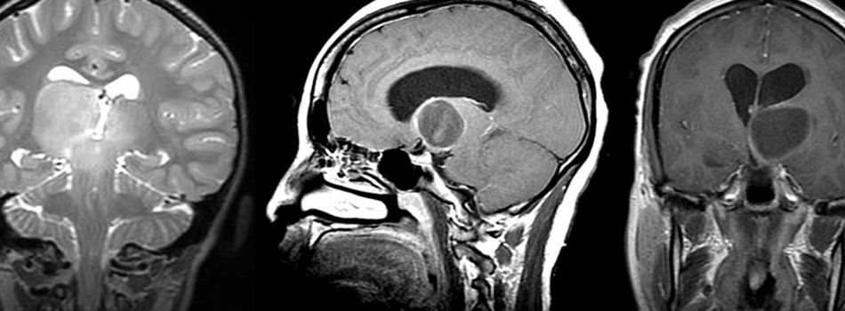 <a href='/bingzhong/jiaozhiliu/' target='_blank'><u>胶质瘤</u></a>手术