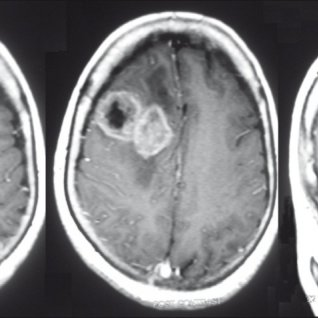 <a href='/jibing/naojiaozhiliu/1803.html' target='_blank'><u>胶质瘤手术</u></a>