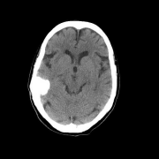 脑膜瘤钙化意味着什么