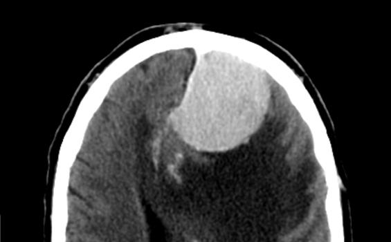 问：脑膜瘤三级生存期是多少？