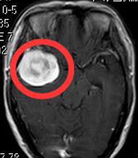 右侧颞部脑膜瘤要怎么治疗？手术切除有望治愈