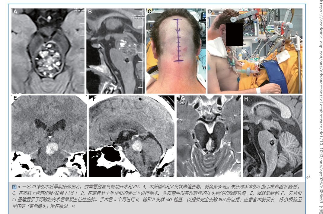 脑海绵状血管瘤案例
