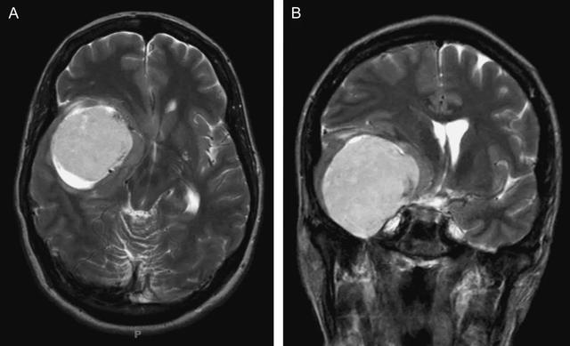 <a href='/bingzhong/naomoliu/' target='_blank'><u>脑膜瘤</u></a>