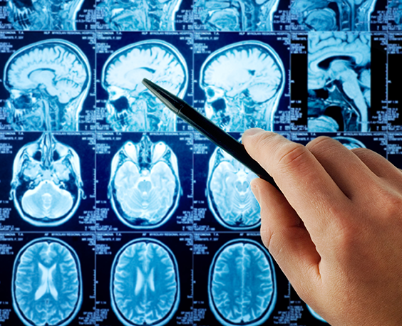 阿尔茨海默病终于有药可医，中国原创新药GV-971正式上市