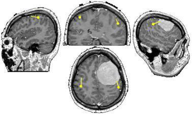 女教师脑膜瘤手术后失去秀发，全班男孩剃光头陪伴