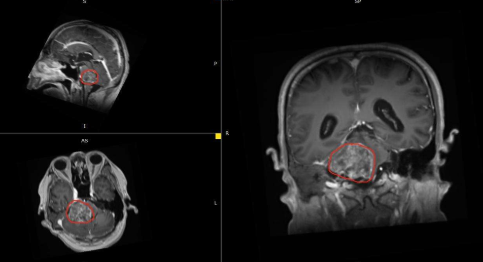 低级别<a href='/bingzhong/jiaozhiliu/' target='_blank'><u>胶质瘤</u></a>