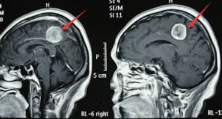 脑膜瘤案例