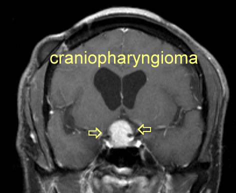 颅咽管瘤能治好吗？