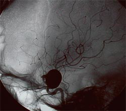 上海看脑血管瘤有哪家医院好