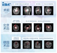 “头上动刀”，这些胶质瘤患者选择出国手术的N个理由