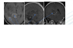 脑瘤到底优选手术、放化疗、靶向药还是临床试验？