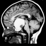 儿童颅咽管瘤寿命?手术全切有望治愈颅咽管瘤