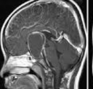 颅咽管瘤不治疗会怎样?随着肿瘤增大会威胁生命