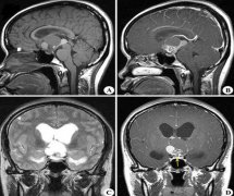 颅咽管瘤遗传给子女吗？