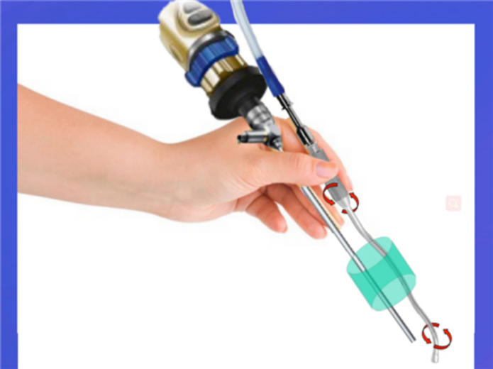 儿童颅咽管瘤全切除可能吗？