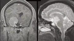 脑膜瘤WHOI级会复发吗？复发性脑膜瘤治疗方法解读