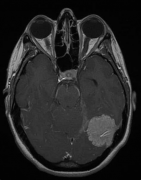 脑膜瘤症状有哪些？脑膜瘤好治吗？