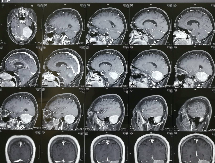 镰旁脑膜瘤是病吗？手术难度大吗？