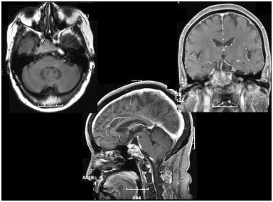 <a href='/qianyan/luyanguanliu/' target='_blank'><u>颅咽管瘤</u></a>