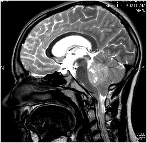 髓母细胞瘤能活多久？