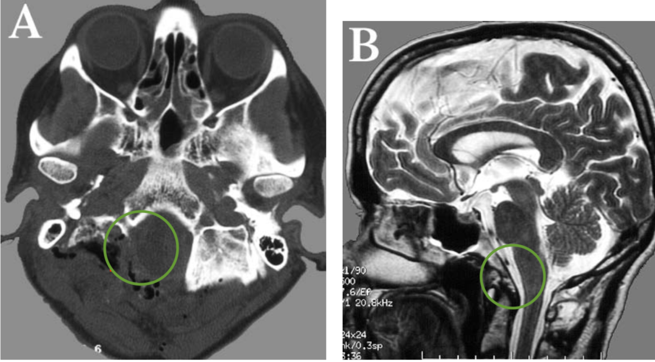 枕骨大孔区脑膜瘤图片1