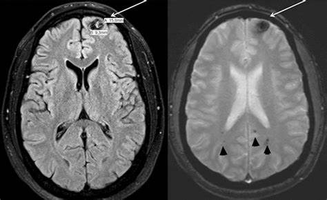 脑海绵状血管瘤