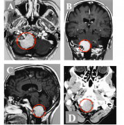 位置“刁钻”的脑膜瘤怎样才能“全切”? | 枕骨大孔脑膜瘤全切过程记录