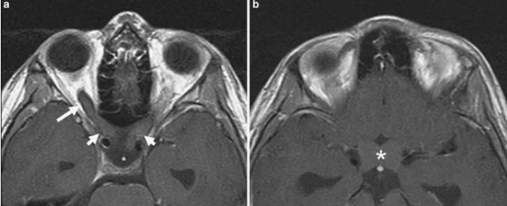 <a href='/bingzhong/ssjjzl/' target='_blank'><u>视神经胶质瘤</u></a>